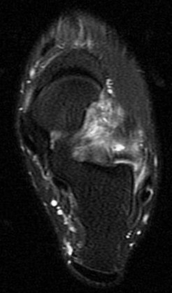 Figure 4 for case sinus tarsi  syndrome ( RID3222 )